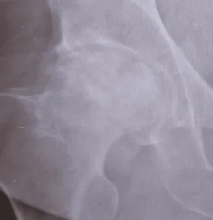 Close-up X-ray of Dan's hip joint showing an irregular, partly collapsed ball of the femur